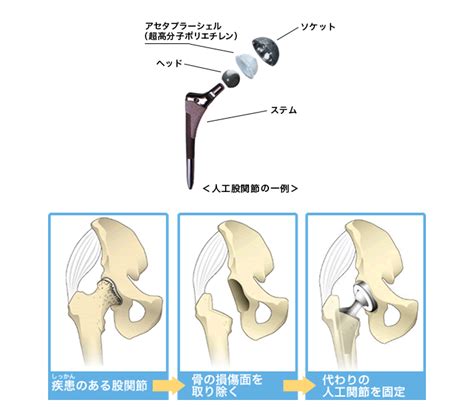 骨枯手術費用|人工関節置換術の費用はいくらかかるの？治療にかか。